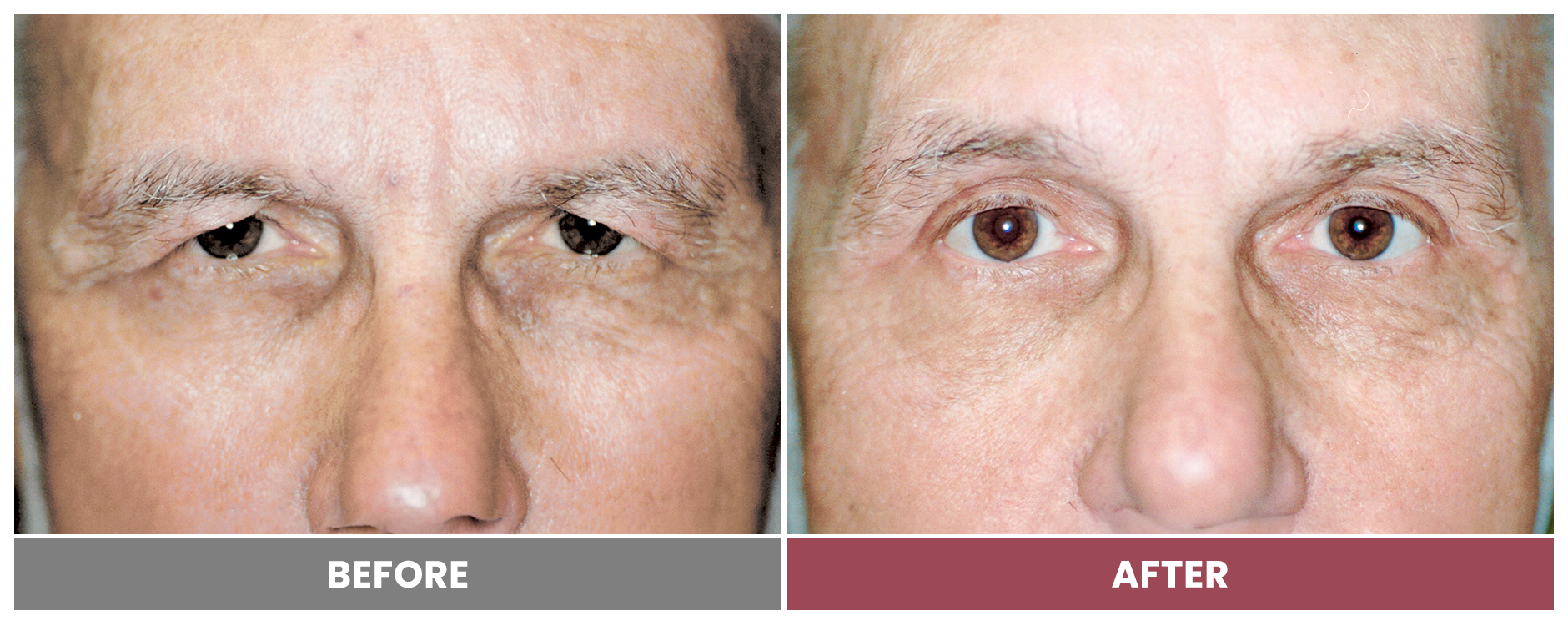 Upper Blepharoplasty - Case 34